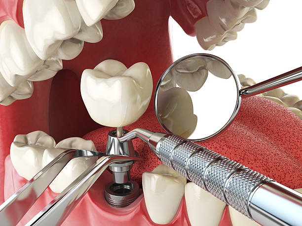 Best Knocked-Out Tooth (Avulsed Tooth) Treatment in Tennille, GA